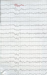 Ηλεκτροεγκεφαλογράφημα στις ΑΝΟΙΕΣ