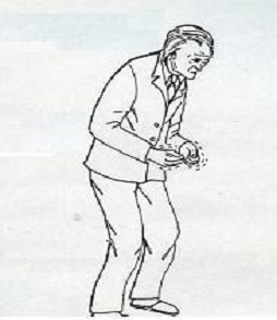 parkinson Σύνδρομο Parkinson