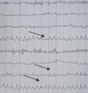 Τα Λ κύματα του ηλεκτροεγκεφαλογραφήματος