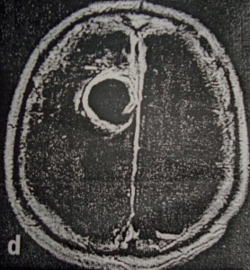 Νευρολογία-Ψυχιατρική-Οι ψυχώσεις και το ηλεκτροεγκεφαλογράφημα (3)